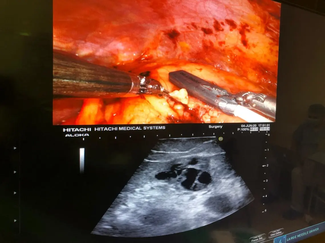 cirugia robotica en los tumores renales - Cómo es la operación de un tumor en el riñón