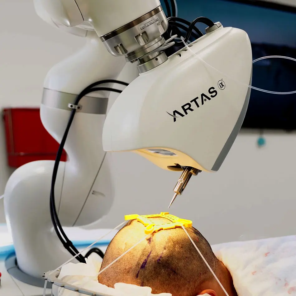 artas robot precio - Cuánto cuesta un trasplante de cabello robótico Artas