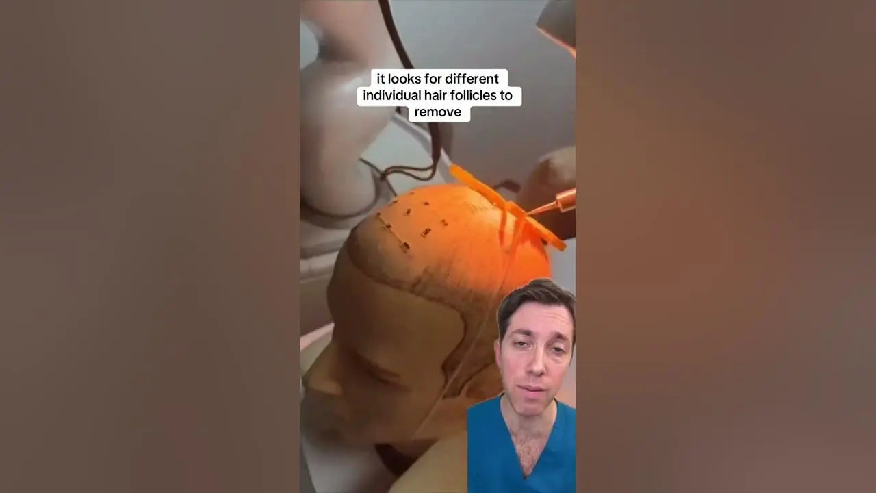 robotic hair replacement - Does robotic hair transplant work