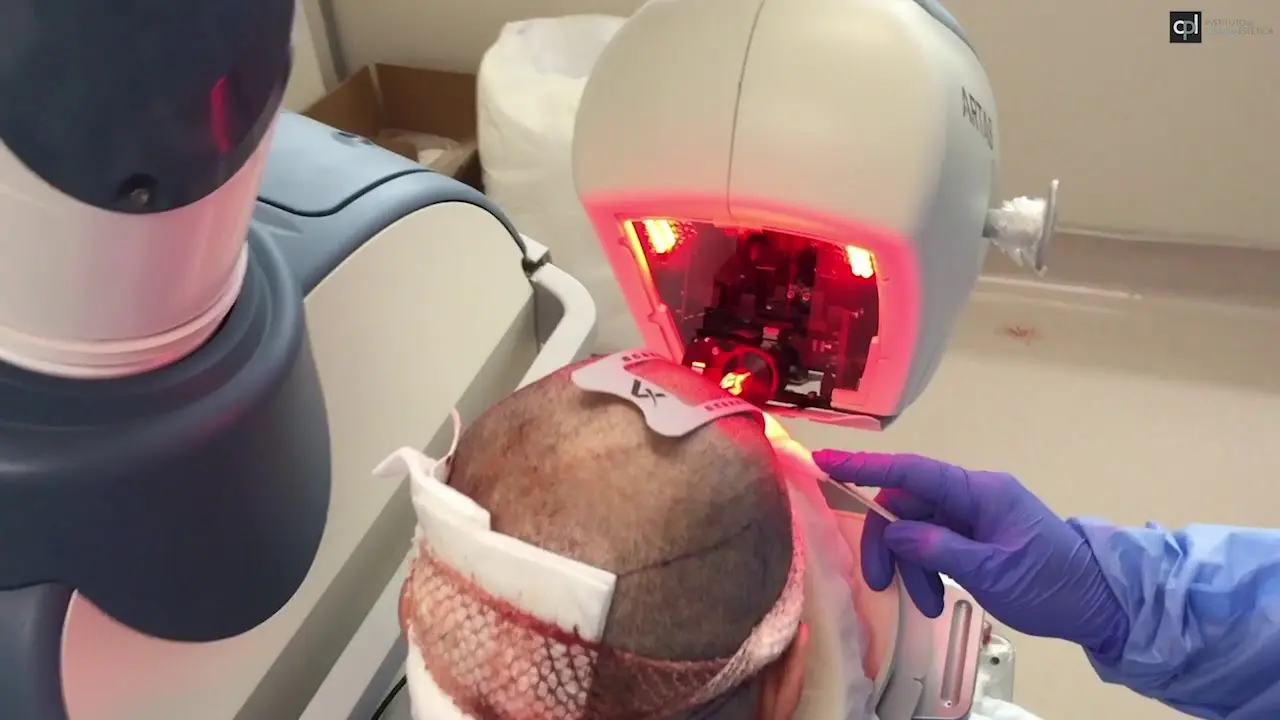 implante capilar robotica - Funciona el trasplante de cabello robótico