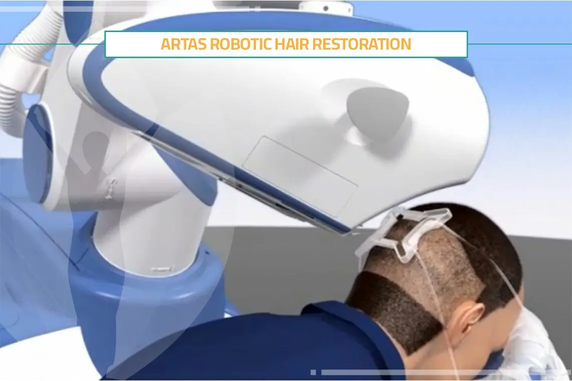 artas robot cyprus - How long does Artas last