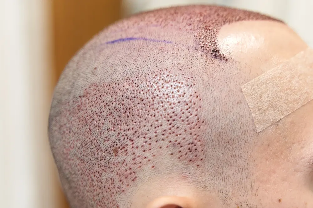robotic hair replacement - How much do 3,000 hair grafts cost