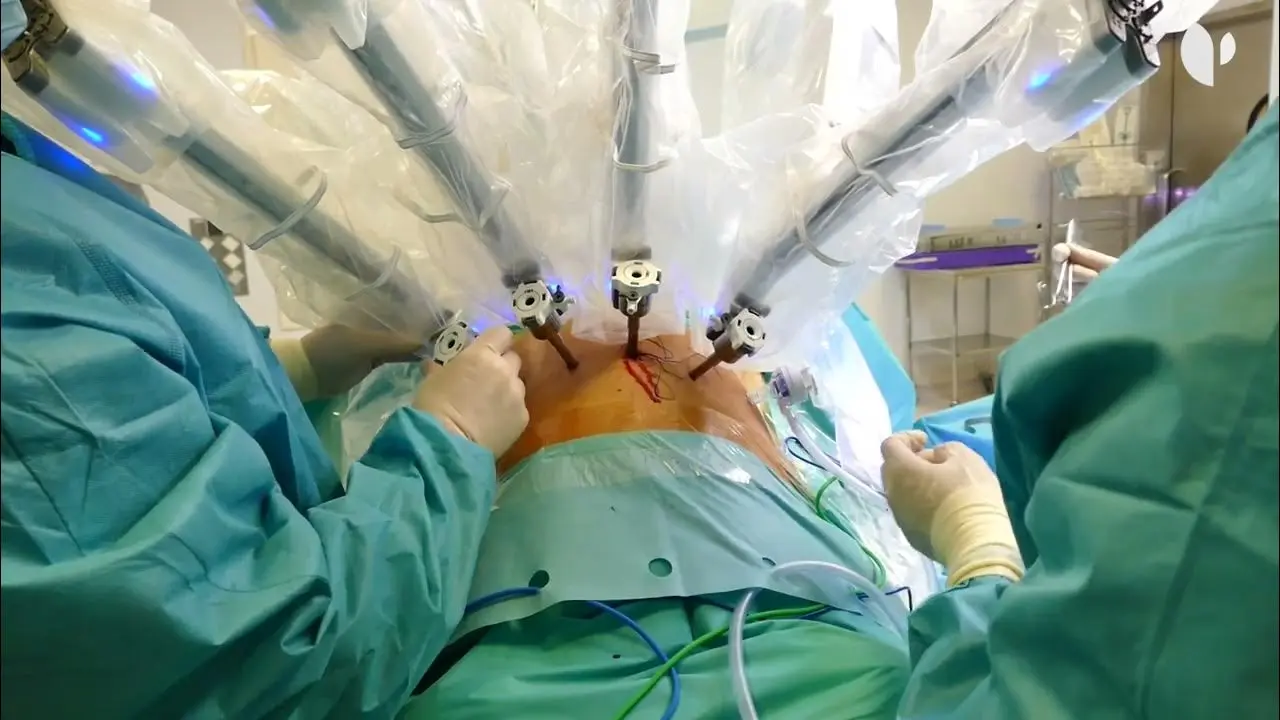 Cirugía Robótica para la Próstata: Una Guía Completa - Qué tan exitosa es la cirugía robótica para el cáncer de próstata cirugia robotica operación de próstata - Qué tan exitosa es la cirugía robótica para el cáncer de próstata